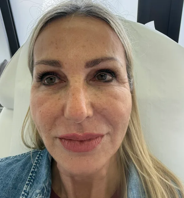 After-facethree