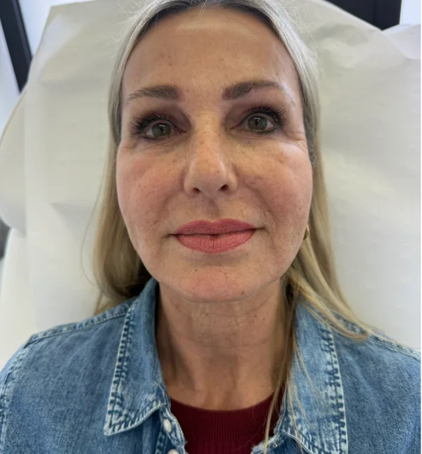 Before-facethree